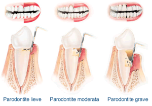 paradontite1