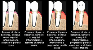 paradontite2